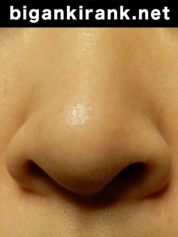 鼻の毛穴アフター画像